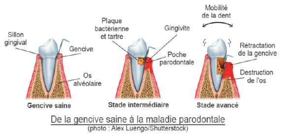 parodondite